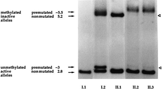 Fig. 3. Results of the southern blot assay at the FMR-1 locus. / Lane numbers correspond to individuals in the pedigree and fragment sizes are indicated in kilobases at the side of the figure. The father (I.1) exhibits a normal pattern with a unique 2.8-kb band corresponding to his unmethylated active X-chromosome, whereas in normal females both bands of 2.8 kb and 5.2 kb are present and correspond to their active and inactive alleles (individual II.1). The mother (I.2) exhibits a pattern of 4 bands, suggestive of a premutated allele in the methylated and unmethylated states (bands of ∼5.5 kb and 3 kb, respectively). Subjects I.2 and II.1 exhibit a random X-chromosome inactivation as indicated by an equal intensity of each fragment. The twins (II.2 and II.3) show a pattern of 4 bands like their mother but 2 bands are weaker (white arrowheads), indicating a skewed X-chromosome inactivation.