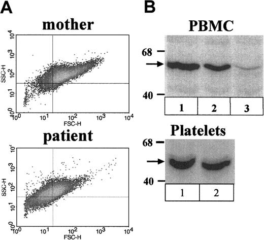 Fig. 2. Analysis of platelets and PBMCs. / (A) Flow cytometric analysis of platelets. Shown are density plots of isolated platelets stained with FITC-CD41of the patient's mother (top panel) and the patient (bottom panel). Note the decreased mean forward scatter of the patient's platelets relative to those of her mother. (B) Western blots stained with WASP W-485 antibody. Shown are PBMCs (top panel) and platelets (bottom panel) of the (1) patient's mother, (2) the female patient, and (3) PBMCs of an unrelated typical WAS patient (exon 2; G252A).