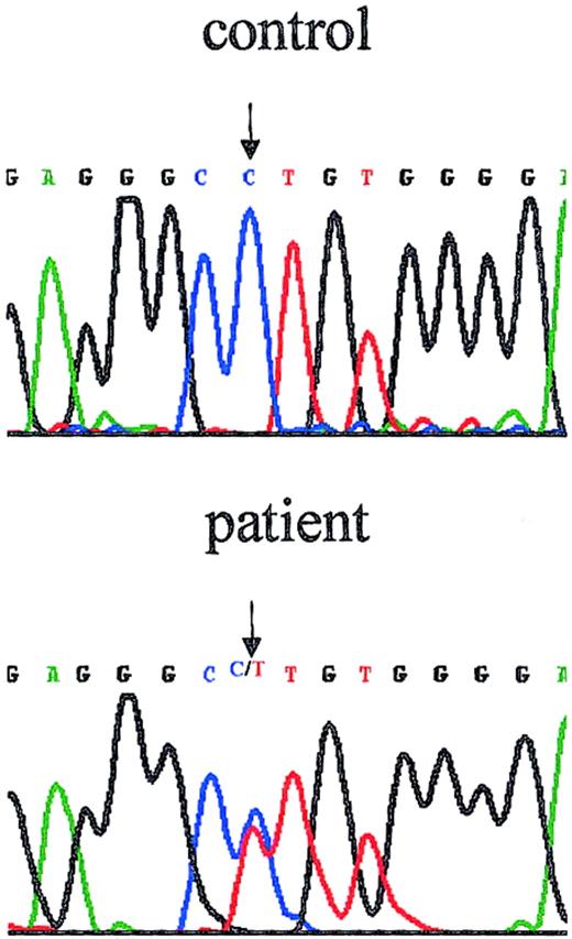 Fig. 3. The female patient is heterozygous for WASPmutation. / The chromatograph shows the reverse direction sequence of the region that includes the intron 6 border. The patient's sequence exhibits 2 peaks at position (−1), precisely the position of the mutation previously reported for her maternal cousin (IVS6 −1G>A).