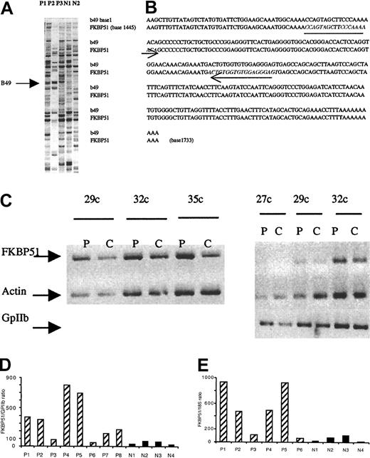 Fig. 1. Characterization of FKBP51 as a gene overexpressed in PMF megakaryocytes. / (A) PCR differential screening. mRNA from normal or PMF spontaneously grown megakaryocytes were reverse transcribed and amplified by PCR using AP76 and H-T11-A primers (Genhunter). Amplified cDNAs were run side by side on a sequencing gel. The arrow indicates b49 band only amplified in myelofibrosis samples. (B) Alignment of b49 (288 bp) and FKBP51. Alignment was performed using LFASTAn-LALIGNn program from Infobiogen (Villejuif, France). Sequence homology was 99.6%; b49 alignment was located at the 3′end of the cDNA (base 1445-1733). The 2 18mer initially used to confirm the differential expression in semiquantitative RT-PCR are underlined. (C) Semiquantitative RT-PCR from normal (C) and pathologic (P) MKs. Internal differential display primers were designed from b49 and 27, 29, 32, and 35 cycles were performed to amplify actin and GPIIb. Similar results were obtained with 2 other pathologic samples. (D,E) Real-time quantitative RT-PCR. Real-time quantitative RT-PCR was performed with RNA extracted from spontaneously growing MKs from 8 patients (P1-P8) and MKs grown in presence of SCF and TPO from 4 controls (N1-N4). MKs were immunomagnetically purified; purity of recovered cells was determined by flow cytometry and was over 90%. Ratio of FKBP51 expression on GPIIb mRNA expression showed a 2- to 10-fold increase in FKBP51 expression except in one patient (P6). P6 presented an acute transformation of the disease. The same results were obtained with a ratio between FKBP51 expression and 18S in 6 patients (P1-P6; panel E).