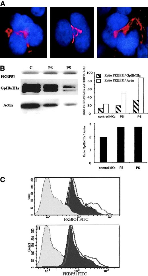 Fig. 2. Expression of FKBP51 in normal and IMF MKs. / (A) Immunofluorescence localization of FKBP51 in normal MKs. Normal MKs were cultured from CD34+ cells in the presence of TPO and SCF. After cytocentrifugation, cells were fixed, permeabilized, and labeled with an anti-FKBP51 mAb. TRITC-labeled donkey antimouse F(ab′)2 was used as secondary antibody. Cells were counterstained with DAPI (4,6 diamidino-2-phenylindole). Localization of FKBP51 in the different MK samples (in red) was analyzed using a fluorescence microscope. A cytoplasmic labeling was observed with a peculiar pattern, which could correspond to the Golgi apparatus. Original magnification, × 1000. (B) FKBP51 expression in normal and pathologic MKs studied by Western blot. Protein extracts from spontaneously growing MKs from 2 patients (P5 and P4) and one normal leukapheresis product, CD34+cell-derived MKs (cultured in presence of TPO), were separated by SDS-PAGE. Immunoblotting was performed with the anti-FKBP51 antibody, anti–GpIIb-IIIa antibody, and an antiactin antibody in the same membrane. Ratios of FKBP51/GpIIb and FKBP51/actin are illustrated as well as GpIIb/actin ratio. An increase in the FKBP51/GpIIb and FKBP51/actin ratios was observed in the 2 samples derived from PMF, whereas the GpIIb/actin was almost constant. (C) Differential FKBP51 protein expression in normal and IMF MKs by flow cytometry. Spontaneously growing MKs from IMF patients and normal MKs were doubly labeled with an anti-VWF polyclonal antibody and an anti-FKBP51 mAb by indirect immunofluorescence. Analysis of FKBP51 expression was performed in the VWF+e gate. In panels Ci and Cii, the histogram filled in gray illustrates the control isotype(IgG-FITC). The histogram filled in black illustrates the graph of a healthy control. The unfilled curve in black line shows the graph of 2 different patients. In panel Ci, 2 other controls are shown (gray lines). The 3 control sample curves are superimposed. The 2 illustrated patient MKs express a low but significant increase in FKBP51 expression.