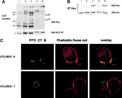 Fig. 5. KIR engagement prevents Vav tyrosine phosphorylation and the reorganization of actin cytoskeleton. / (A) Tyrosine phosphorylated protein patterns were analyzed by immunoblot from total cell lysates of nonstimulated 4D4 CTLs (lane 1) or incubated 3 minutes at 37°C with RCC-7 (lane 2) or RCC-6 cell lines (lane 3). Ptyr-protein profile of RCC-7 (lane 4) and RCC-6 (lane 5) alone are shown. The lower panel shows membrane reprobing with mAb against SLP-76; * indicates SLP-76 band, the upper band is nonspecific detection of tumor cell proteins. (B) Postnuclear lysates of nonstimulated CTLs (lane 1) or stimulated by RCC-7 targets were immunoprecipitated with polyclonal anti-Vav antibodies and analyzed for tyrosine phosphorylation. CTL was stimulated by RCC-7 alone (lane 2), or in presence of anti–HLA-B/C (lane 3) or control anti–HLA-DR mAbs (lane 4); alternatively CTL was stimulated by RCC-6 (lane 5). Lower panels show membrane reprobing with anti-Vav30 mAb. (C) Confocal analysis was performed as indicated above. 4D4 CTL clone labeled by FITC–CT-B (green) was stimulated with RCC-6 (upper panels) or RCC-7 (lower panels) for 10 minutes at 37°C. After permeabilization, fixed cells were stained with Phalloidin-Texas red (red). This picture represents an overlay and the side-side picture of the overlay showing labeled lipid rafts (FITC–CT-B) or Phalloidin-Texas red as indicated.
