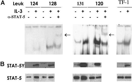 Fig. 6. Stat5 expression and activation. / Cells from AML patients in the group with normal IL-3Rα levels and patients exhibiting high IL-3Rα expression were incubated for 15 minutes at 37°C either in the absence (−) or in the presence (+) of IL-3. TF1 cells were used as a control for Stat5 activation by IL-3. (A) Total cell extracts (20 μg) were analyzed by EMSA using a specific radiolabeled oligonucleotide corresponding to the SBE motif present within the β-casein promoter. Supershift assay was performed after incubation of cell extracts with anti-Stat5 as indicated. Arrows indicate the supershifted band. (B) Thirty micrograms whole-cell lysates was separated on 7% SDS-PAGE, transferred to a nitrocellulose membrane, and blotted sequentially with the indicated antibodies to evaluate Stat phosphorylation status (STAT-5Y) and protein content (STAT-5). These are representative EMSA and immunoblot experiments that were repeated 3 times with cell extracts from different AML patients.