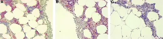 Fig. 6. Immunohistologic staining of OPG in a BM biopsy of a myeloma patient. / (A) BM biopsy stained with anti–syndecan-1, (B) anti-OPG, and (C) negative control antibody CK-7 as described in “Patients, materials, and methods.” The staining for OPG was abolished by preincubation of anti-OPG with recombinant human OPG (not shown). Original magnification × 200.
