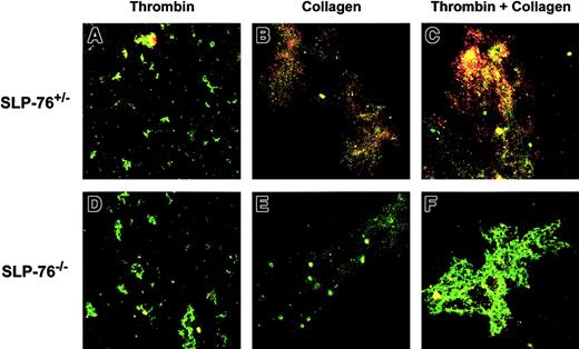 Fig. 6. Confocal photomicrographs of annexin V binding with fibrinogen-adherent platelets. / Following adherence to fibrinogen-coated coverslips, SLP-76+/− (A-C) or SLP-76−/− (D-F) platelets were stimulated with thrombin (0.5 U/mL; A,D), collagen (50 μg/mL; B,E), or thrombin plus collagen (C,F). Adherent platelets and platelet aggregates were identified by staining with FITC anti-CD49b (green fluorescence) and annexin V binding was detected by staining with PE-conjugated annexin V (red fluorescence). Yellow fluorescence indicates costaining for both CD49b and annexin V binding. Original magnification × 200.