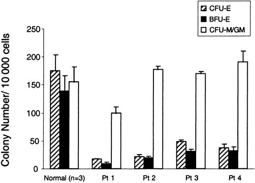 Fig. 1. Severe reduction of erythroid colonies in RPS19-deficient patients with DBA. / The bar graph shows the number of erythroid and myeloid progenitor colonies from bone marrow cells of RPS19-deficient patients with DBA and a healthy individual. CD34+ cells (10 000) from patients with DBA (Patients 1-4) and normal healthy donors were plated in methylcellulose in the presence of erythropoietin (CFU-Es and BFU-Es) or IL-3 and GM-CSF (CFU-M/GM). CFU-Es (hatched bars) were scored on day 7. The number of BFU-E (black bars) and CFU-M/GM (white bars) colonies were scored on day 14. The mean ± SEM for 3 experiments is shown. The frequency of erythroid colonies is significantly reduced in patients versus contols (P < .04, Wilcoxon rank sum test) but no difference was found with regard to CFU-M/GM colonies. One experiment with 3 independent plates is shown.