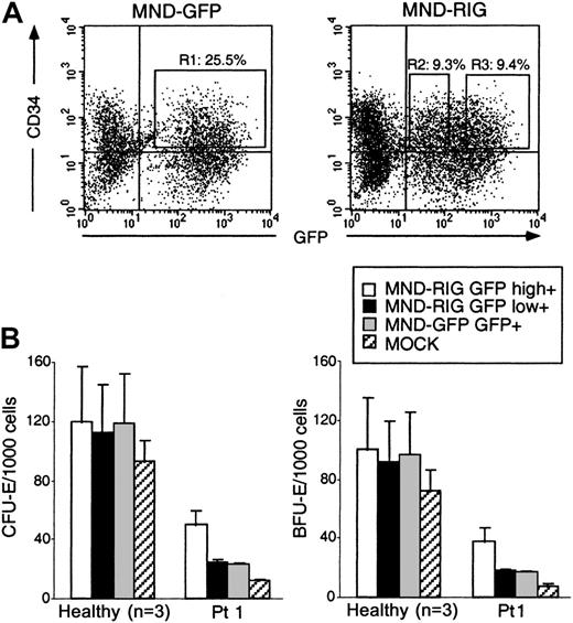 Fig. 6. High RPS19 transgene expression increases erythroid colony formation. / Transduction of bone marrow cells from DBA patient 1 using the MND-RIG vector and the MND-GFP control vector. (A) Flow cytometric analysis of transduced CD34+ cells. The transduced GFP+ and CD34+ cells (squared fractions) were sorted by FACSVantage. R1: MND-GFP–transduced CD34+/GFP+ fraction. R2: MND-RIG–transduced CD34+/GFPlow fraction. R3: MND-RIG–transduced CD34+/ GFPhighfraction. (B) A quantity of 1000 transduced progenitor cells (GFP+ and CD34+ cells) were embedded in methylcellulose in the presence of erythropoietin and SCF. CFU-E and BFU-E colonies were scored on day 7 and day 14, respectively. Open bars indicate the number of colonies from MND-RIG–transduced GFPhigh cells. Black bars indicate the number of colonies from MND-RIG–transduced GFPlow cells. Gray bars indicate the number of colonies from MND-GFP–transduced GFP+ cells. Hatched bars indicate the number of colonies from the mock-transduced, unsorted fraction. One experiment was performed and 3 plates were counted in a blinded fashion. The mean ± SEM are shown.