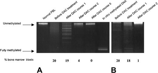 Fig. 4. Methylation changes of the 5′ p15 gene during decitabine treatment visualized by DGGE. / (A) Bone marrow cells of patient 019 before and after courses 1, 2, and 6 of DAC treatment were analyzed by DGGE as described in “Patients, materials, and methods.” The PCR reaction was initiated by “hot start,” followed by 39 cycles at 94°C for 20 seconds, 55°C for 20 seconds, and 72°C for 30 seconds, and a final extension at 72°C for 5 minutes. Normal PBCs and in vitro methylated DNA served as negative and positive controls, respectively. Methylated alleles migrate farther than unmethylated alleles. The percentage of bone marrow blasts (relative to the nonerythroid cell fraction) is given below each lane. (B) Bone marrow cells of patient 013 before treatment and after courses 1 and 2 were analyzed by DGGE as described above.