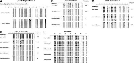 Fig. 5. Variable hypermethylation of individual p15 alleles is reduced by repeated courses of decitabine. / Analysis of p15 (5′ region, A-D) and p16(exon 2, E) methylation status was determined by sequencing of individual alleles subcloned from bisulfite-treated, PCR-amplified DNA. Normal peripheral blood cells of 2 healthy individuals (A) and bone marrow MNCs from MDS patients 013 (B), 016 (C), and 019 (D,E) were analyzed. Each row represents a single cloned allele. ○, nonmethylated CpG; ●, methylated CpG. Numbering of nucleotides is according to published sequences. Count of methylated CpGs is given for each clone. Bone marrow aspirates for evaluation of hematologic and cytogenetic response were performed between 5 and 8 weeks (median, 6 weeks) after a treatment course. Percent of abnormal metaphases are given on the right. Metaphase cytogenetics were performed as described elsewhere.13 *Cytogenetics were performed on a second aspirate done 47 days later. nm, no metaphases obtained due to lack of dividing cells.