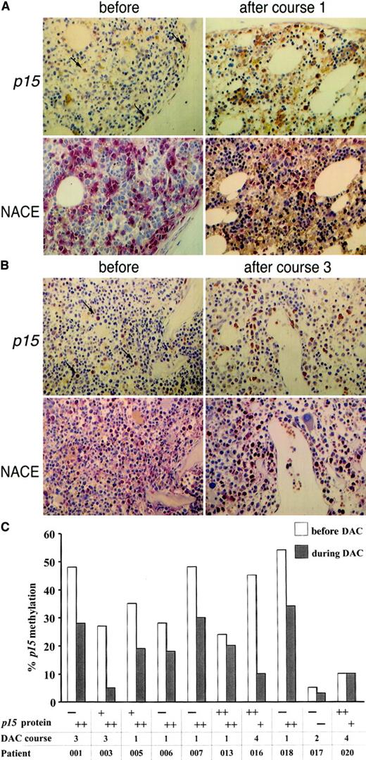 Fig. 6. p15 protein expression in MDS bone marrow cells is up-regulated with p15 demethylation during decitabine treatment. / (A) Bone marrow biopsy from patient 006 before (left) and after (right) 1 course of treatment; magnification, × 40. Upper panel:p15 staining; lower panel: granulocytes and precursors detected by naphthol AS-D-chloroacetate esterase (NACE) staining. Arrows indicate p15 staining in isolated cells prior to treatment. (B) Patient 001 before (left) and after (right) 3 courses of treatment. Immunohistochemical staining of myeloid precursors was scored semiquantitatively by visual inspection for 3 categories: −, completely negative or only few dispersed positive cells; +, a moderate number of cells stained positive; ++, the majority or all cells stained positive. (C) 8 patients with p15 hypermethylation (> 15%) were examined for p15 expression prior to treatment (white columns) and at time of maximal hypomethylation (gray columns) and 2 patients with p15 methylation lower than 15%. An abnormal karyotype was present prior to treatment in all patients except 006, 017, and 020. Complete reversion to normal karyotype at time of maximal hypomethylation (gray columns, course number given below) occurred only in patient 003.