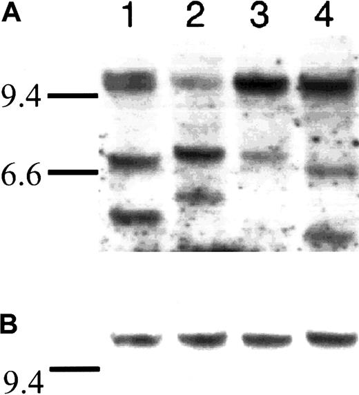 Fig. 1. Southern blot assay used to detect legitimate and illegitimate rearrangements at the IgH locus. / Southern blot of 4 WM samples that were fractionated on an agarose gel, blotted, and hybridized sequentially with a JH probe (A), and a 5′ Sμ probe (B). Horizontal bars at the left of each exposure correspond to λHindIII markers, with the 9.4-kb marker in each lane but the 6.6-kb marker included for panel A. Panel A shows the genomic DNA probes with a JH oligonucleotide probe and the corresponding clonal bands (variable size) and germ line fragments (approximately 10 kb). Panel B shows the constant size of the 5′ Sμ probe indicating lack of legitimate or illegitimate rearrangements. The total amount of genomic DNA loaded was 2.5 μg per lane.
