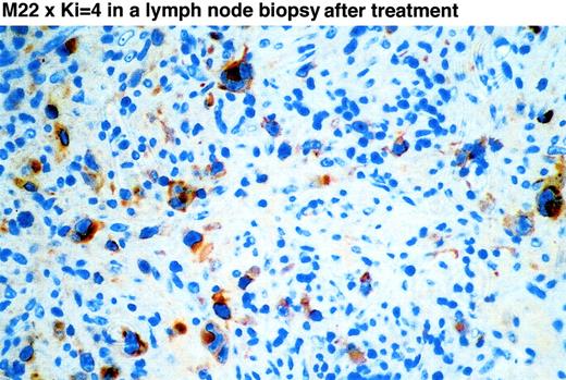 Fig. 4. Immunohistochemical detection of H22xKi-4 in a lymph node biopsy after treatment. / For the immunohistochemical investigation, the tissue was deparaffinized, cut into sections of 5 μm, and blocked with pig serum for 10 minutes to reduce unspecific staining. To detect the murine part of the bispecific molecule (Ki-4 F(ab′)), a polyclonal rabbit antimouse Ab was applied and incubated at 4°C overnight, followed by a biotylinated pig antirabbit antibody and a standard biotin-streptavidin kit. Finally, the slides were stained with fast red. There is clear staining of the H-RS cells. The numerous small lymphocytes in the specimen are negative. The biopsy of a second patient showed an identical staining pattern.
