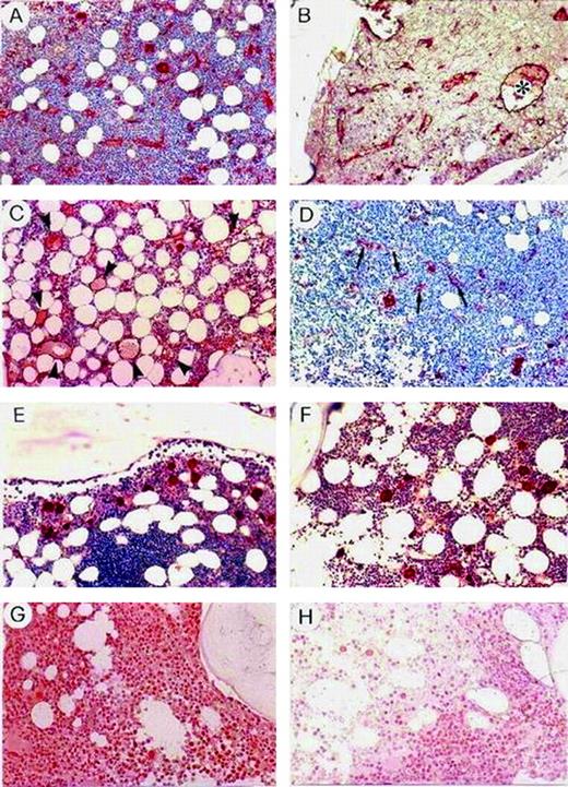 Fig. 2. Staining of BCLL BM with FVIII-RA. / (A-C) Patients with microvessel area and number at least at the 75th percentile. Note in panel B an enormously dilated neovessel (*), and in panel C, numerous microaneurysmatic dilations of neovessels (arrowheads). (D,E) Patients with lower area and number. Note in panel D, straight, not branched neovessels (arrows), and in panel E, a tumor nodule devoid of neovessels. (F) A control subject with anemia due to vitamin B12 deficiency. In panels D, E, and F, megakaryocytes strongly stained with the FVIII-RA are recognizable. Staining of BM BCLL with VEGF (G) in the same patient as in panel B and (H) in the same patient as in panel D. Original magnification for all panels, × 250.