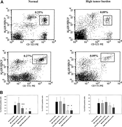 Fig. 1. CD123 and CD11c populations of dendritic cells, but not CD14 monocytes, are significantly depleted in patients with SzS. / (A) PBMCs from a healthy donor and an SzS patient with high tumor burden were excluded of all lineage-positive cells (cells stained with Lin 1–FITC cocktail, containing antibodies against CD3, CD14, CD16, CD19, CD20, CD56), whereas lineage-negative cells were analyzed for the coexpression HLA-DR and CD11c or CD123. The right upper quadrant numbers represent the percentage of dendritic cells expressing HLA-DR and CD11c or CD123. (B) PBMCs from age-matched healthy donors, mycosis fungoides patients, and SzS patients with different levels of tumor burden were analyzed for the presence of dendritic cells, as described in panel A. Monocytes were defined by the expression of CD14, and only CD14high cells were analyzed. Data represent means (±SD) of tested patients and are presented as a percentage of all PBMCs gated on forward and side light scatter. *P < .001; **P < .01; ***P < .05 compared with healthy donors. Control antibodies stained 0.1% of PBMCs.