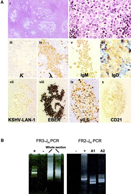 Fig. 1. Analysis of KSHV-associated GLD. / (A) Histologic and immunophenotypic features of KSHV-associated GLD in case 1: The germinal centers are replaced by large cells with a moderate amount of amphophilic cytoplasm and a large vesicular nucleus containing 1 or 2 prominent nucleoli. These large cells coalesce and form confluent aggregates (panels i-ii, hematoxylin-eosin staining). They express high levels of cytoplasmic Ig (monotypic Igλ, IgM/D) and are therefore termed plasmablasts (iii-vi). Plasmablasts are positive for both KSHV (vii) and EBV (viii), and most of them express vIL-6 (ix). CD21 staining shows that KSHV-positive cells occur within meshworks of follicular dendritic cells (x). Original magnification i, × 40; ii-iv, × 600; vii-x, × 400. (B) Clonality analysis of KSHV-associated GLD in case 1: FR3-JH PCR analysis of DNA samples from whole tissue sections shows a weak dominant band in a polyclonal background. FR2-JH PCR analysis of microdissected KSHV-positive foci (A1 and A2 from case 1) shows an oligoclonal pattern.