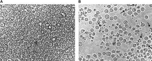 Fig. 6. Morphology of CEM cells treated with AN-9. / CEM cells were treated with either 75 μM AN-9 (A) or with 0.1% DMSO (B; control) for 20 hours and then photographed using the SPOT camera. Magnification was ×10 for both samples. Arrows indicate fragmented nuclei and clusters of membrane-bound bodies characteristic of apoptosis.