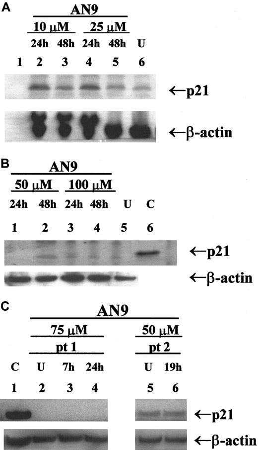 Fig. 7. Western blot analysis of p21 in primary ALL. / Protein was extracted by the SDS/boiling method from (A) infant ALL; (B) B-precursor ALL; and (C) T-ALL cells treated with AN-9 as indicated. SJ SA-1 osteosarcoma cells, known to express p21, were used as the positive control. Western blot analysis was performed using a p21 antibody at 0.5 μg/mL. Equal amounts of protein in each lane were verified by probing the blot with a β-actin antibody at 2 μg/mL. U indicates untreated (0.1% DMSO); C, positive control for p21; pt, patient. AN-9 IC50 in the infant ALL was 13 μM in a 3H-thymidine uptake assay.