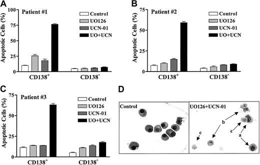 Fig. 11. Primary CD138+ MM cells display selective sensitivity to UCN-01/UO126–induced apoptosis. / CD138+ and CD138− cells were isolated from the bone marrow of MM patients as described in “Materials and methods.” The cells were exposed individually or in combination to drugs as follows: UO126 (A: 25 μM; B and C: 20 μM); UCN-01 (A: 150 nM; B: 250 nM; C: 100 nM). After 24 hours' treatment, the extent of apoptosis was determined by evaluating Wright-Giemsa–stained cytospin preparations as described previously. Values represent the means ± SD for more than 20 randomly selected fields encompassing more than 300 cells. Representative microphotographs of cells obtained from patient #2 are shown in D, a: early apoptotic cells; b: late apoptotic cells; c: postapoptotic (ghost) cells.