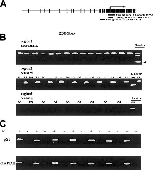 Fig. 1. Methylation and expression analysis ofp21CIP1 in acute lymphocytic leukemia. / (A) Map of the p21CIP1 CpG island. Each vertical mark indicates a CpG pair. The arrow indicates the initiation of the transcription start site. Region 1 indicates de location of COBRA primers. Region 2 of MSP1 primers, and region 3 of the MSP 2 primers. Note that region 3 corresponds to the area studied by Roman-Gomez et al. (B) Examples of COBRA (region 1), MSP1 (region 2), and MSP2 (region 3) assays. SssItr indicates the methylated positive control. The arrow indicates the restricted methylated band. M indicates methylation-specific MSP reactions, U, unmethylated reactions. (C) RT-PCR reactions. + indicates reactions with reverse transcriptase; –, without.