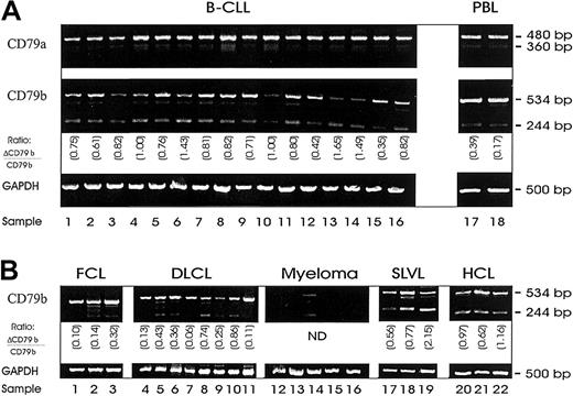 Fig. 1. Messenger RNA expression of alternative transcripts of CD79, ΔCD79a and ΔCD79b. / Shown are DNA fragments resulting from semiquantitative RT-PCR of RNA isolated from malignant B cells with primers specific for CD79a, CD79b, or glyceraldehyde-3-phosphate dehydrogenase (GAPDH) (Table 1). Messenger RNA was first isolated from samples and then reverse transcribed to yield cDNA for PCR. Primers for GAPDH were used to verify integrity and quantity of cDNA. (A) RT-PCR from 16 B-CLL samples. (B) RT-PCR from a selection of other B-cell malignancies: follicle center cell lymphoma (FCL) (lanes 1-3); diffuse large B-cell lymphoma (DLCL) (lanes 4-11); myeloma (lanes 12-16); splenic lymphoma with villous lymphocytes (SLVL) (lanes 17-19); and hairy cell leukemia (HCL) (lanes 20-22). The ratios in each panel show the relative level of ΔCD79b/CD79b.
