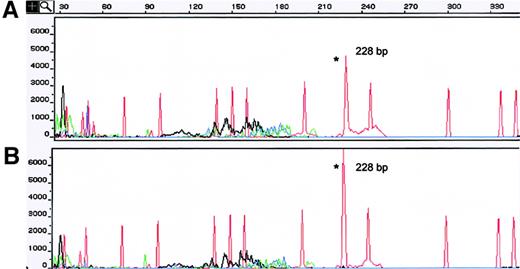 Fig. 1. TCR-γ analysis of concurrent MF skin biopsy specimens showing a common clonal GR. / (A) A skin sample obtained from the right thigh showed a dominant TCR-γ gene rearrangement (GR) of 228 bp using the VγI primer. (B) The second specimen, obtained from left-thigh skin, showed an identical dominant T-cell GR (same Vγ family and the same size). Asterisks indicate TCR-γ GRs. The red peaks without asterisks correspond to internal size standards. Red indicates VγI; blue, VγII; black, VγIII; and green, VγIV.