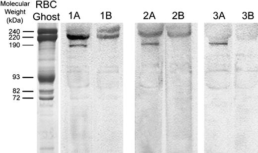Fig. 7. Western blot analysis of the α1A subunit of voltage-gated calcium channels in human erythrocyte ghosts from 3 different donors. / Red cell membrane proteins were separated electrophoretically at high protein loads (80 μg). After electrophoretic transfer to nitrocellulose paper, blots were stained with antibodies directed against residues 865 to 881 of the α1A subunit of the rat brain voltage-gated calcium channel (lanes 1A, 2A, 3A). Because several nonspecific bands were also visualized, competition of Cav2.1 antibody staining using its specific peptide was also performed. For this purpose, 10 μg of the Cav2.1 antibody was preincubated with 10 μg of antibody-specific peptide for 1 hour at 22°C and then further incubated with the blot for 2 hours at 22°C (lanes 1B, 2B, 3B). Polypeptides with Mr of approximately 190 000 and 220 000 are characteristic of the major splicing variants of the α1A subunit of Cav2.1 in the brain. An SDS-PAGE Coomassie blue–stained gel of RBC membranes (left lane; “RBC Ghost”) serves as an approximate molecular weight marker.