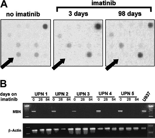 Fig. 1. MBN expression after initiation of imatinib therapy. / (A) A cDNA-array plot. A patient's mRNA before, as well as 3 and 98 days after, initiation of imatinib therapy was isolated, reverse transcribed, radiolabeled, and then used to probe Atlas 1.2 human cDNA arrays. Arrows indicate the dot location at which theMBN-specific DNA was deposited on the array membrane. The intensity of the signal dots corresponds with expression levels in the tested sample. Plots are representative of arrays on 2 individual CML patients treated with imatinib. A comparable loss of the MBN spot intensity was seen in both tested patients. (B) Regulation of MBN transcript levels under imatinib therapy as assessed by reverse transcriptase–PCR (RT-PCR). RNA was isolated from 5 patients in chronic phase of CML at diagnosis and at 4 and 12 weeks after start of imatinib therapy. At this time, at least a complete hematological remission was achieved. Lower panel: β-actin PCR was used to assess equal loading and integrity of RNA.