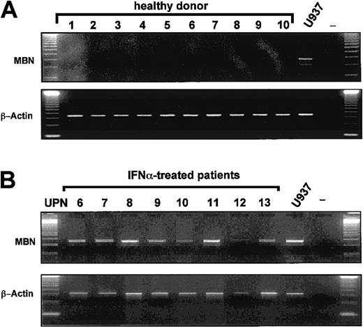 Fig. 2. MBN transcription in healthy donors and IFN-α–treated patients as assessed by RT-PCR. / The lower blots in each panel display transcription levels of the housekeeping gene β-actin as reference gene for healthy donors and IFN-α patients. MBN+ U937 cells served as a positive control cell line. (A) Lack of MBNtranscription in the peripheral blood of healthy donors (1 to 10); positive control (U937), and PCR negative control. (B) MBNtranscript levels of IFN-α–treated CML patients in major or complete cytogenetic remission UPN6-13. Positive and negative controls, U937 and —.