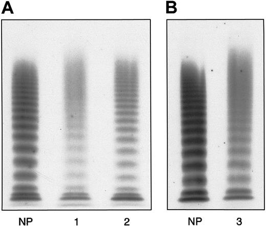 Fig. 1. Plasma VWF multimer pattern obtained by electrophoresis of denatured, nonreduced samples in a 1.2% agarose gel containing 0.1% SDS. / After running, fixing, and washing, multimers were detected by125I–anti-VWF polyclonal antibody. At the top are large multimers, at the bottom the small forms. (A) Proband's pattern (1) compared with normal plasma (NP) and a type 1 VWD (2). (B) The father's pattern (3) compared with NP. The patterns in A and B represent different gels electrophoresed under the same experimental conditions. In the proband and his father only the first 6 to 7 oligomers are detectable, even though to a lesser extent than the normal counterpart and type 1 VWD, whereas the higher forms appear as a continuous smear.