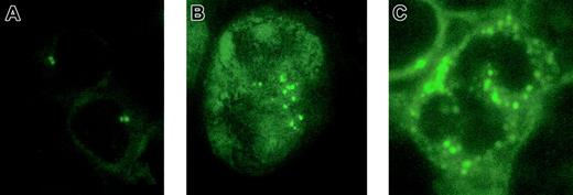 Fig. 1. Centrosome aberrations in acute myeloid leukemia. / Indirect immunofluorescence staining of normal bone marrow (A) and acute myeloid leukemia cells (B-C). Cells were immunostained with an antibody to pericentrin, followed by a FITC-conjugated secondary antibody. Original magnification × 1000.