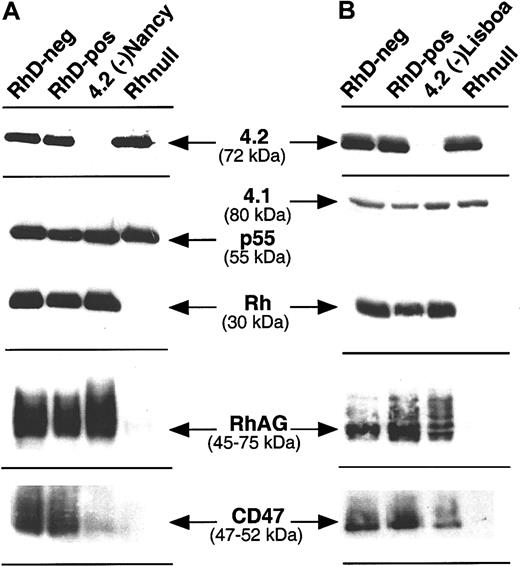 Fig. 1. Immunostaining of RBC membrane proteins from 4.2(-)Nancy and 4.2(-)Lisboa HS erythrocytes. / RhD-positive (DCCee), RhD-negative (dccEe), and Rhnull(amorph type) membrane proteins were used as controls. Anti–protein 4.2 polyclonal antibody was used to confim the lack of the 72-kDa band in the 2 samples of 4.2(-). Antibodies against the major members of the Rh complex were as follows: anti-Rh (D+ CcEe): PAb MPC8; anti-RhD: MoAb LOR15-C9; anti-RhAG: MoAb LA18.18; anti-CD47: MoAb 6H9. PAbs against the p55 and 4.1 proteins, which belong to the GPC-4.1-p55 membrane complex, were used as controls to show that similar amounts of membrane proteins were present on each lane.