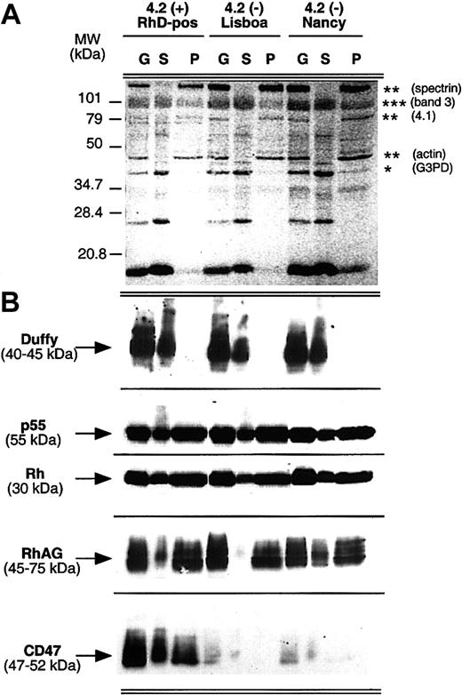Fig. 4. Comparison of Triton X-100 extractibility of the Rh complex from normal and 4.2(-)HS red blood cells. / Human erythrocyte ghosts (G) were extracted with 1% Triton X-100, and the soluble (S) and insoluble (pellet, P) fractions were analyzed by immunoblotting. (A) As a control of extraction, red Ponceau staining of the nitrocellulose membrane revealed the expected fractionation of proteins between the soluble (*) and pellet (**) pools, with band 3 (***) in both fractions. (B) Immunostaining of Rh complex proteins was performed as described in the legend to Figure 1A. Anti–Duffy MAb was used as a control of membrane solubilization efficiency. Anti-p55 was used as a control of the protein amount loaded for each normal and variant sample.