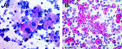 Fig. 2. Intracellular localization of CTLA-4 in activated CD34+ stem cells and AML neoplastic cells. / (A) Immunostaining with the biotin-conjugated anti–CTLA-4 scFv67 and AP-labeled streptavidin of neoplastic cells from peripheral blood of an AML patient. (B) Immunostaining with the anti–CTLA-4 BN13 mAb and AP-labeled antimouse immunoglobulin antibody of CD34+ stem cells activated with GM-CSF for 7 days. Staining was performed on cytospins, visualized by the addition of phosphatase substrate, and counterstained by hematoxylin (original magnifications: panel A, × 70; panel B, × 110). Panel A and B stainings show cytoplasmic and membrane positivity for CTLA-4.