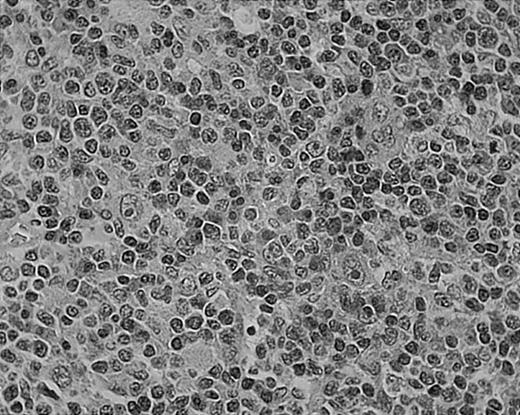 Fig. 5. Tissue eosinophilia in NS HD. / Note typical Hodgkin cells surrounded by clusters of eosinophils. Stained with hematoxylin and eosin (H&E). Original magnification, × 400.