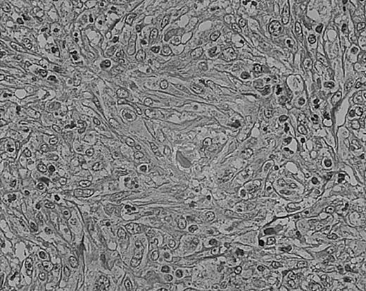 Fig. 6. Lymphocyte depletion in NS HD. / This example shows lymphocytes in less than 33% of all cells. Stained with H&E. Original magnification, × 400.