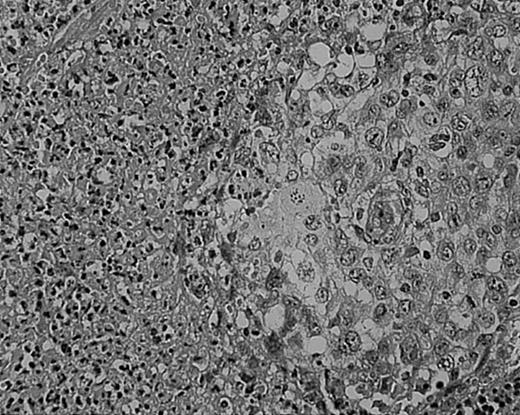 Fig. 7. Cellular atypia (left-side confluent necrosis) in NS HD. / This example shows more than 25% of H/RS cells presenting with bizarre and anaplastic appearances. Stained with H&E. Original magnification, × 400.