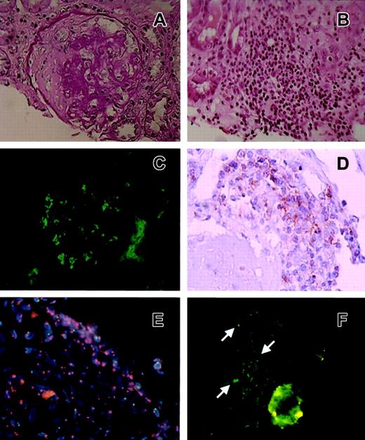 Fig. 1. Histologic and immunohistologic results of the renal biopsy sample. / (A) A glomerulus of the percutaneous biopsy specimen showing mesangial proliferative nephritis with a fibrotic crescent. Periodic acid-Schiff (PAS) stain; original magnification, × 200. (B) The interstice was massively infiltrated with mononuclear cells shown by light microscopy. Hematoxylin-eosin (HE) stain; original magnification, × 100. (C) Immunofluorescence results showing a glomerulus of the percutaneous biopsy specimen with severe IgA deposition at the mesangial region and along the glomerular loops. Original magnification × 200. (D) Immunohistologic results with the anti-CD8 antibody. Original magnification, × 200. (E) FISH study using a PE-conjugated X chromosome–specific probe and an FITC-conjugated Y chromosome–specific probe. Infiltrated cells had 2 red spots, indicating that infiltrated mononuclear cells in the interstice were donor-derived (female) cells. Original magnification, × 100. (F) Immunofluorescence micrograph of a glomerulus with anti-OMHP antibody. OMHP antigen deposition was mainly in mesangial areas (arrows). Original magnification, × 200.