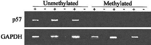 Fig. 5. RT-PCR analysis of ALL patients. / + indicates with reverse transcriptase (RT); −, without RT. Bottom blots show GAPDH control.