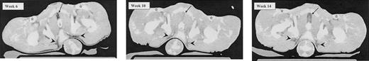 Fig. 9. Loss of fat or increased density of fatty tissue in an IL-7–treated male animal at week 10. / This is particularly notable in the area between symphysis pubis and urethra (arrows) and laterally from the rectum (arrowheads). The circular area underneath the rectum represents the tail. For orientation, femoral vessels are marked by stars. All 3 pictures have windows set at 260/0 HU.