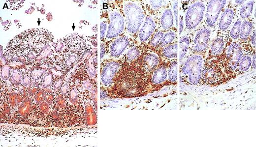 Fig. 10. Animal with GVHD-like disease. / Small bowel from the animal that developed GVHD-like disease shows enterocyte denudation (arrows) and T cells (brown) infiltrating the lamina propria. (A) CD3 immunostain. (B-C) Close-up views immunostained for CD4 (B) and CD8 (C) show damage to basal crypts. Macroscopically, small bowel mucosa showed flat villi. All other organs sampled were infiltrated with T cells (both CD4 and CD8), including colon, kidneys, heart, skin, lungs, pancreas, and liver. In the liver, T cells infiltrated more the portal spaces than the parenchyma. In agreement with that, during IL-7 administration alkaline phosphatase peaked at 26 times above baseline, γ-glutamyltransferase 12 times above baseline, alanine aminotransferase 2 times above baseline, and bilirubin 3 times above baseline. The thymus was small, barely visible, at autopsy and microscopically contained few CD3+ cells (both CD4+ and CD8+); the corticomedullary junction was indistinct. Spleen and mesenteric LNs were moderately enlarged, whereas axillary and inguinal LNs were of normal size. No germinal centers were present; most cells in the spleen (both in the white and red pulp) and in the LNs were T cells (both CD4+ and CD8+); B cells (CD20+) were markedly decreased. Viral inclusions or syncytia were not seen in any of the organs sampled. Original magnifications, × 30 (A) and × 50 (B-C).