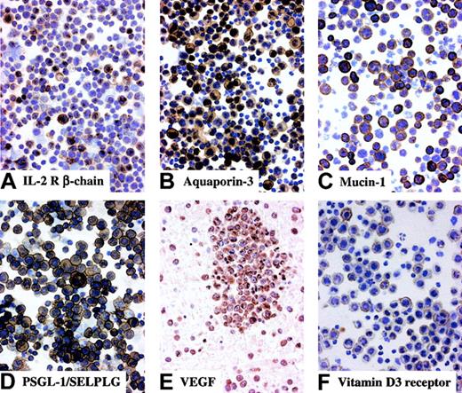 Fig. 4. Immunohistochemical analysis of molecules expressed by PEL. / Most tumor cells in clinical samples of PEL display multiple protein expression with membranous and/or cytoplasmic staining. Cytospin preparations, avidin-biotin-peroxidase complex immunostaining, hematoxylin counterstain; original magnification, × 250 (A-D,F); section from cell block, avidin-biotin-peroxidase complex immunostaining, hematoxylin counterstain; original magnification, × 250 (E).