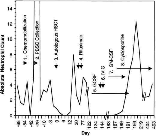 Fig. 1. Absolute neutrophil count during the course of treatment. / (1) The patient received chemomobilization therapy with rituximab 375 mg/m2, days −54 and −47, cyclophosphamide 4 g/m2 intravenously, day −52, mesna 1.33 g/m2, thrice a day on day −52, etoposide 200 mg/m2 intravenously on days −52 to −50, and dexa-methasone 10 mg orally four times a day, day −52 to −49. (2) Peripheral blood stem cell collection. (3) Autologous transplant following 12 Gy of linear accelerator radiation, etoposide 60 mg/kg, and cyclophosphamide 100 mg/kg. (4) Posttransplantation rituximab (375 mg/m2 ) was given on days +30 and +37. (5) GCSF 480 μg/day beginning on day +130 and doubled on day +134. (6) Two doses of intravenous immunoglobulin (IVIG). (7) GM-CSF, 250 μg/m2/day. (8) Cyclosporine 200 mg orally twice a day, tapered ultimately to 50 mg orally twice a day.