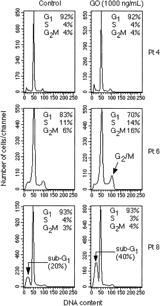 Figure 9. Cell cycle analysis of freshly isolated AML cells. Peripheral blood mononuclear cells from the indicated patients were cultured for 48 hours in the presence of IL-3 and GM-CSF and in the presence or absence of 1000 ng/mL GO. Cell cycle analysis was then performed. The percentages of cells in the sub-G1, G0 /G1, S, and G2/M phases of the cell cycle are indicated in each panel.