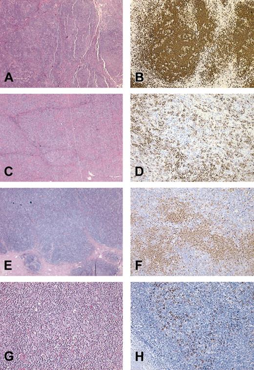 Figure 2. Photomicrographs of LPHD and subsequent transformation. Shown are representative H&E stains (A,C,E,G) and CD20 immunohistochemistry (B,D,F,H) from patient 9 (A-D) and patient 1 (E-H). (A) H&E of initial biopsy of patient 9 showing nodular proliferation of lymphocytes. (B) CD20 stain of initial biopsy highlights large nodules of B cells containing scattered large B cells, characteristic of NLPHD. (C) H&E stain of postrituximab biopsy at low power showing sheets of large atypical lymphocytes, diagnostic of DLBCL. (D) CD20 stain from panel C highlights a focal area in which the large CD20+ B cells are surrounded by negatively stained T cells. (E) H&E stain of initial biopsy from patient 1 showing LPHD with vague nodularity. (F) Anti-CD20 antibody stain from highlights loose nodular aggregates of B lymphocytes. Scattered large CD20+ cells (L&H cells) are present within and outside the B-cell nodules. (G) H&E section of postrituximab transformation to TCR-BCL showing diffuse proliferation of lymphocytes. (H) CD20 stain of DLBCL demonstrates scattered CD20+ large cells with loss of nodularity. The large neoplastic cells are set against a background of T cells. Original magnification, × 150 (A,B,C,E,F) and × 600 (D,G,H).