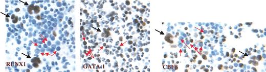 Figure 2. Expression profile of RUNX1, GATA-1, and CBFβ in healthy human bone marrow. Left panel, RUNX1; middle panel, GATA-1; right panel, CBFβ. Black arrows indicate megakaryocytes, and red arrows indicate erythroblasts. Immunoperoxidase staining was performed using avidin-biotin complex on paraffin-embedded marrow clot section. Slides were counterstained with Harris hematoxylin (original magnification, × 400).