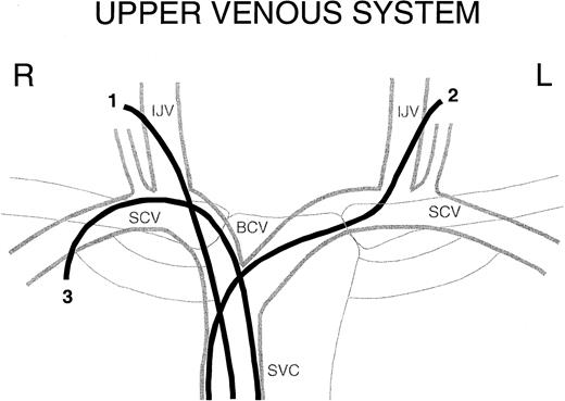 Figure 1. Upper venous system. Schematic of the central upper venous system with examples of a right internal jugular vein CVL (1), a left internal jugular vein CVL (2), and a right subclavian CVL (3). R indicates right; L, left; IJV, internal jugular vein; SCV, subclavian vein; BCV, brachiocephalic vein; and SVC, superior vena cava.