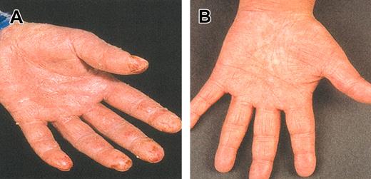 Figure 1. Skin appearance. Before (A) and after (B) 12 weeks of alemtuzumab treatment in patients with advanced erythrodermic MF/SS. Erythroderma, which was present all over the body and caused severe itching and repeated infections, responded gradually to alemtuzumab therapy, and the patient went into unmaintained CR that lasted for 18 months.