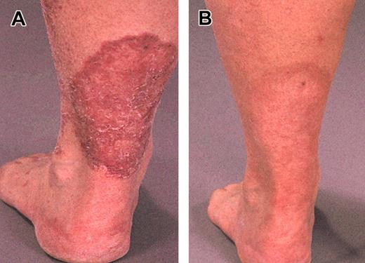 Figure 2. Plaque related to MF/SS. On the lower left leg before (A) and after (B) 12 weeks of alemtuzumab treatment.