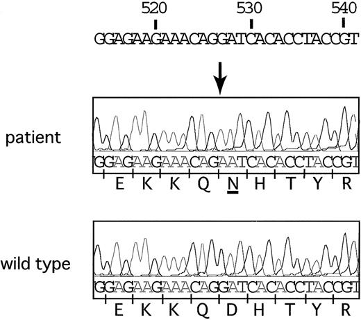 Figure 1. Nucleotide sequence analysis of the ALAS2 gene. Adenine substituted for guanine at position 527 in this patient. This transition resulted in an amino acid change from aspartic acid to asparagine at the 159th amino acid residue.