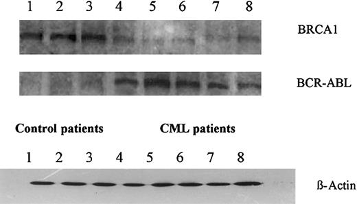 Figure 2. Western blot analysis showing BRCA1 and BCR-ABL expression in primary CML samples and in mobilized peripheral blood (PB) from autografts. Whole-cell extracts were immunoblotted with anti-BRCA1, anti–c-ABL, and anti–β-actin (lanes 1-3, PB from autografts; lanes 4-5, CML blast phase; lanes 6-7, CML accelerated phase; lane 8, CML chronic phase).